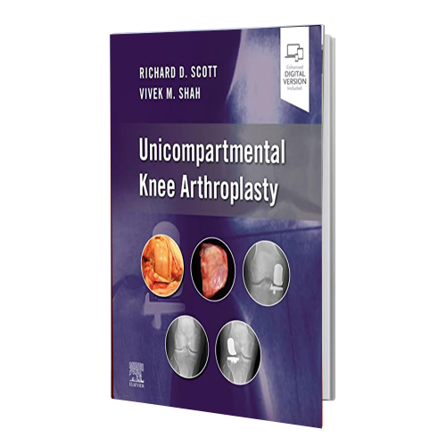 انتشارات رشد مثبت Unicompartmental Knee Arthroplasty