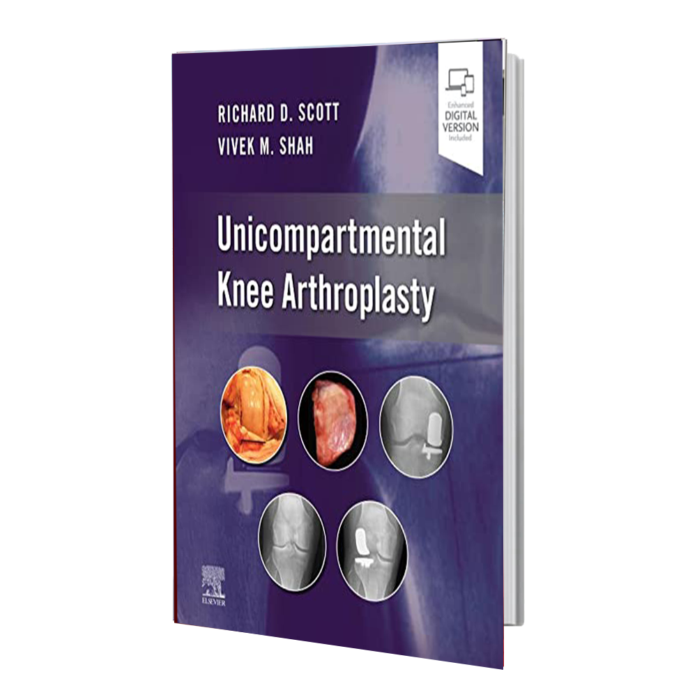 انتشارات رشد مثبت Unicompartmental Knee Arthroplasty